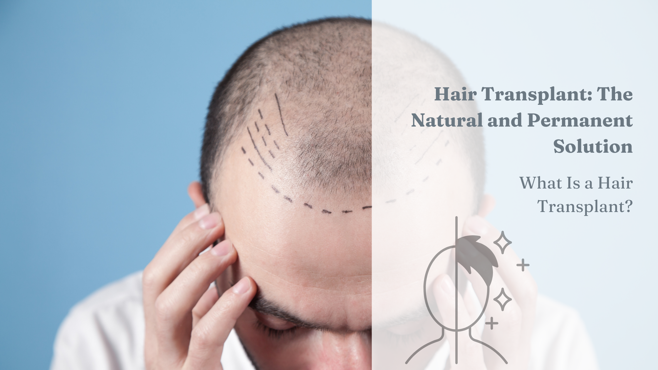 Hair Transplant: The Natural and Permanent Solution